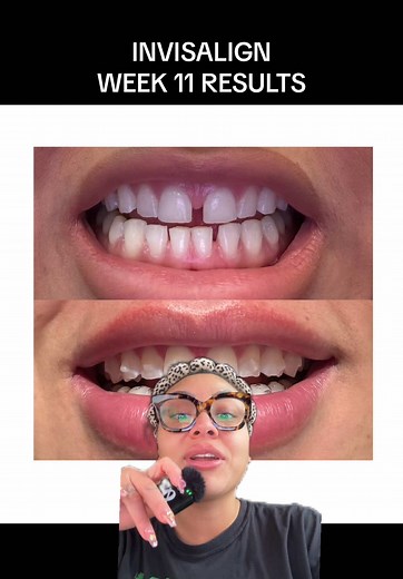 11 Week Invisalign Results Before and After 💫 OMG #greenscreen #invisalign #invisalignjourney #invisaligncheck #invisalignresults #invisalignbeforeandafter