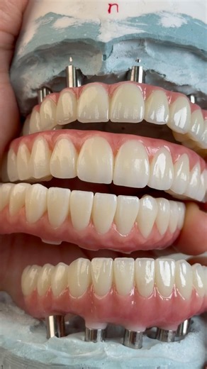 Full Arch Zirconia restoration for Dr. Samantha Chou in Illinois