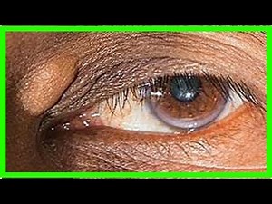 Was sind Xanthome und wie man sie behandelt?