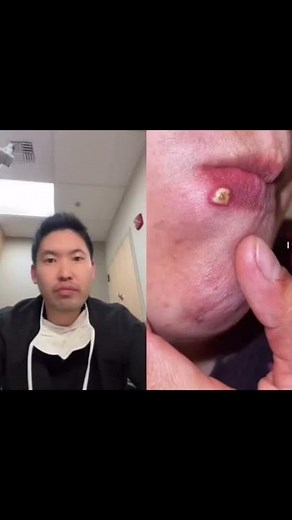#shorts Pimple or Botfly or Cold Sore???