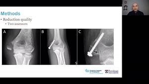 Open Reduction of Medial Epicondyle Fractures in the Pediatric Population: Supine Versus Prone Position