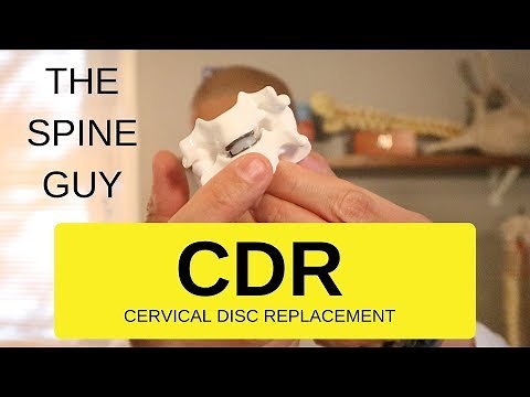 CERVICAL FORAMINAL STENOSIS RADICULOPATHY - PART 6 - CERVICAL DISC REPLACEMENT