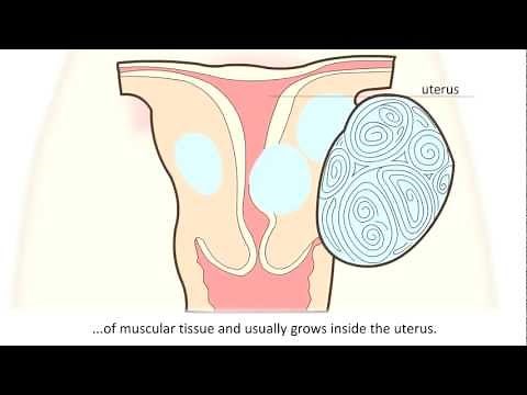 Fibroid - What is a fibroid and how can it be treated?
