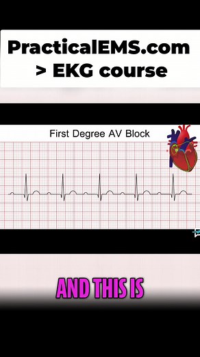 First Degree AV Block Explained: ECG Interpretation Guide