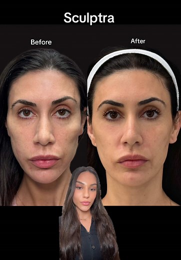 Rejuvenate Your Skin with Sculptra Treatments