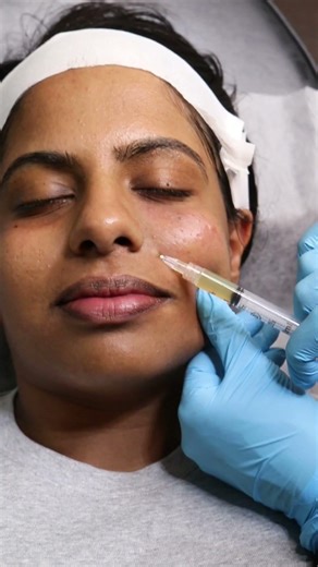 PRP Vampire Facial Treatment | Toronto Medical Aesthetics Instride