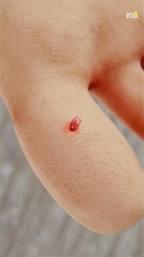 How Suction Splinter removal work