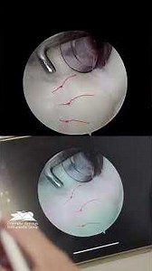 Inside the OR with Dr. Craig Yager: Arthroscopic Treatment for a SLAP Tear