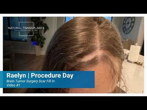 Hair Transplant for a Brain Tumor Surgery Scar, Procedure Day | Dr. Huebner (Raelyn)