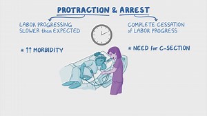 Video: Protraction and arrest disorders: Clinical sciences - Video Explanation! | Osmosis | Osmosis