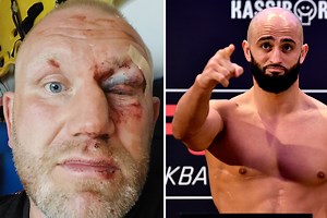 Ex-Bellator MMA star Sergei Kharitonov shows off horror broken eye socket after brutal attack by UFC star Yandiev