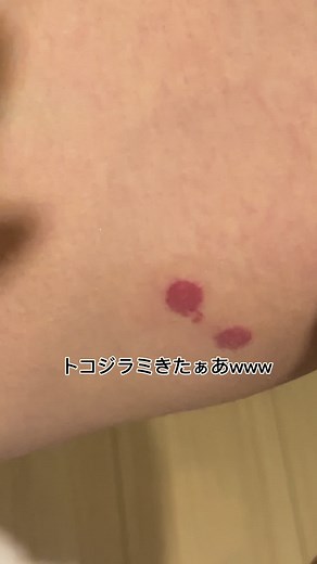 トコジラミの刺され跡が消えない理由