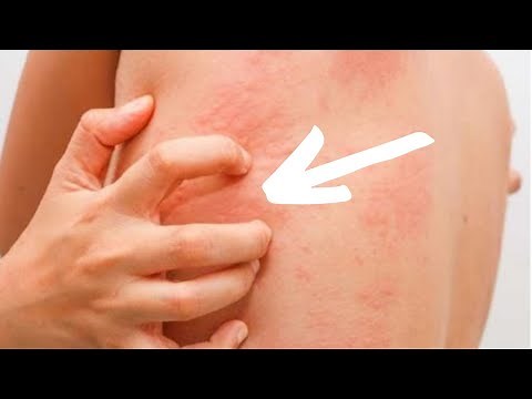 ¿por qué me pica todo el cuerpo? | Cómo Aliviar la Comezón en la Piel