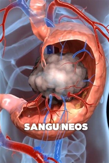 Cómo es el cáncer gástrico por dentro 🧠 (explicado fácil)
