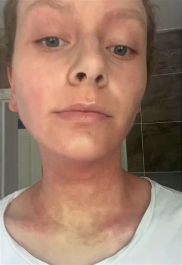 Understanding Topical Steroid Addiction and Awareness