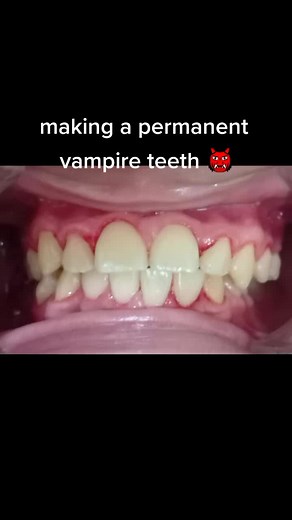 Making Permanent Vampire Fangs: A Cosmetic Dentistry Experience