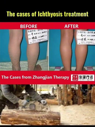 The cases of ichthyosis treatment#ichthyosis#ichthyosisvulgaris #ichthyosistreatment