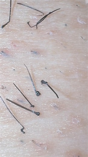 レス解消！♡ #hairremoval #satisfying #毛抜き #埋没毛 #blackheads #pimple #髭抜き