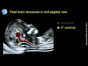 Normal fetal brain anatomy at 11-13 weeks - 2D scan