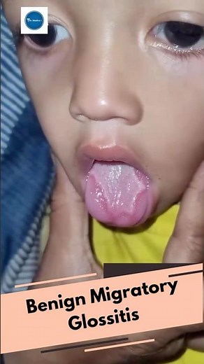 Geographic Tongue || Benign Migratory Glossitis || Dr Medica Clinical cases || Diagnosis ||