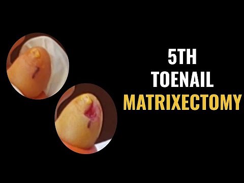 5th Toenail Matrixectomy