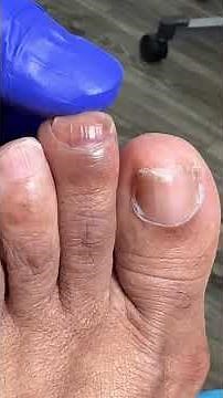 Subungal hematoma #podiatry #subungualhematoma #shoesize