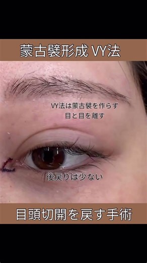 Corrective surgery to reverse canthoplasty: VY method for epicanthal fold formation #ptosis #cosm...