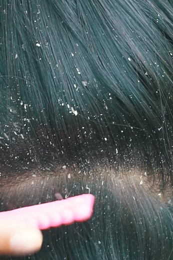 2.7K views · 18 reactions | How relaxing dry scalp and dandruff scratching #dandruff #Scalp #itchy | Denies ASMR | Facebook