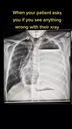 Spotting the Doug in Your Rib Cage X-Ray