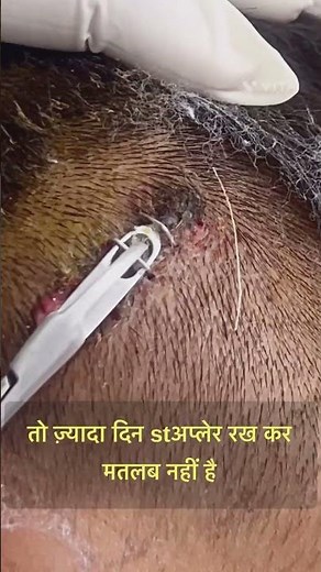 I Cleaned An Infected Stapler Wound