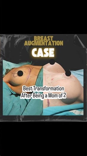 Breast Augmentation Before After Augmentation