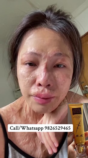 #foryoupageofficiall #foryoupage❤️❤️ #musicas #scarstoyourbeautiful #stretchmarkremoval #operation #musergeneretion #scarystories