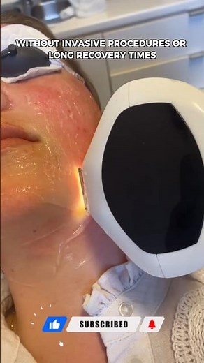 How IPL Technology Reduces Facial Redness and Broken Capillaries ✨