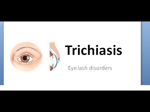 Ophthalmology 379 Trichiasis Eye lash rubbing eye inward eyelash PseudoTrichiasis DisTiChiasis