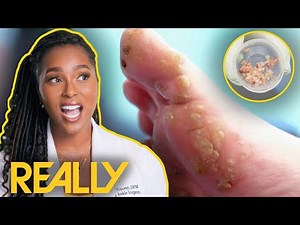 207 Mysterious Growths Removed From Man's Foot | My Feet Are Killing Me