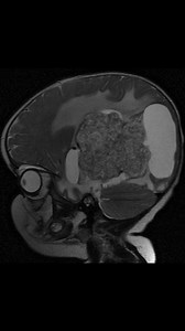 Choroid plexus papilloma | Neurology