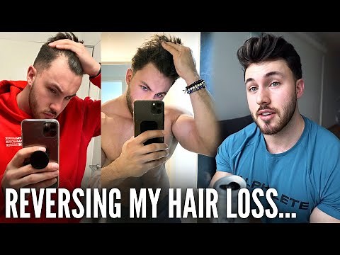HOW I REVERSED MY HAIR LOSS | GYNO SCARE & SIDE EFFECTS…