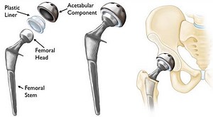 Hip Replacement Surgery- Recovery Time, Alternatives, Risks