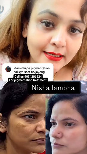 7.4K views · 18 reactions | Call us.9034206224 for permanent pigmentation treatment @nisha_lambha @nisha_lambha_official_ @khaliyat_ #trendingreels #trend #treatment #trending #tbt #video #viral #explore #explorepage #reels #reelsinstagram #goodvibes #facetreatment #fyp #instagram #instagood | Nisha Lambha - Sparsh Beauty Care & Hair Treatment LLP 5 | Facebook