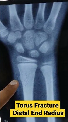 What is Torus Fracture ?Distal End Radius..Dr Sai Chandra