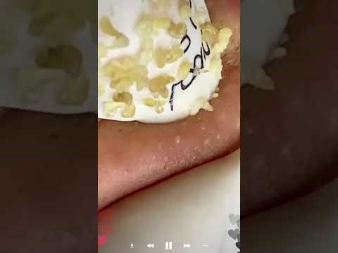 Skincare | Blackheads Removal #723 #tweezers skincare #blackheads blackheads