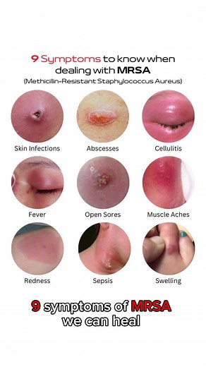 9 symptoms of MRSA we can heal #skinissues #acne #cysticacne #pimples #mymagichealer | Mymagichealer