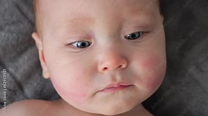 Baby girl with allergic reaction on cheekbones looks at camera. Small child with big blue eyes and red rash on cheeks portrait lying on bed closeup