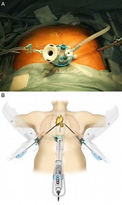 Trans-subxiphoid robotic thymectomy