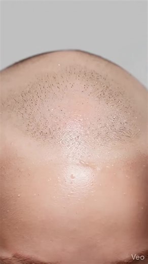 Discover the Best Hair Growth Spray for Men