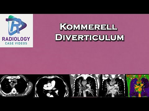 Kommerell Diverticulum