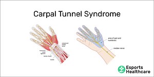 Carpal tunnel syndrome in gamers