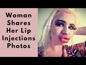 Biggest Lips in the World - Woman Shares Photos Of Her Mouth After 20th Acid Lip Injections