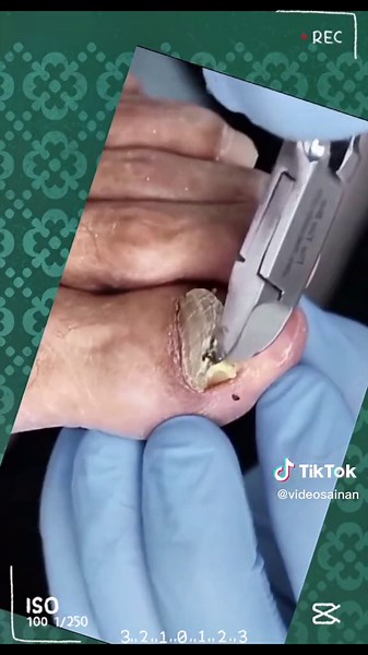 Treating Fungal Toenail Infection: A Step-by-Step Guide