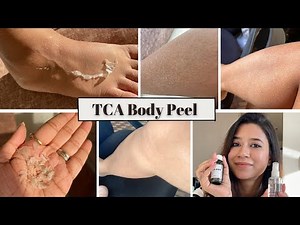 TCA Peel at Home || TCA 15% || Instruction || Before and After || #pigmentation #unevenskintone